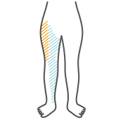 大腿神経痛と外側大腿皮神経痛